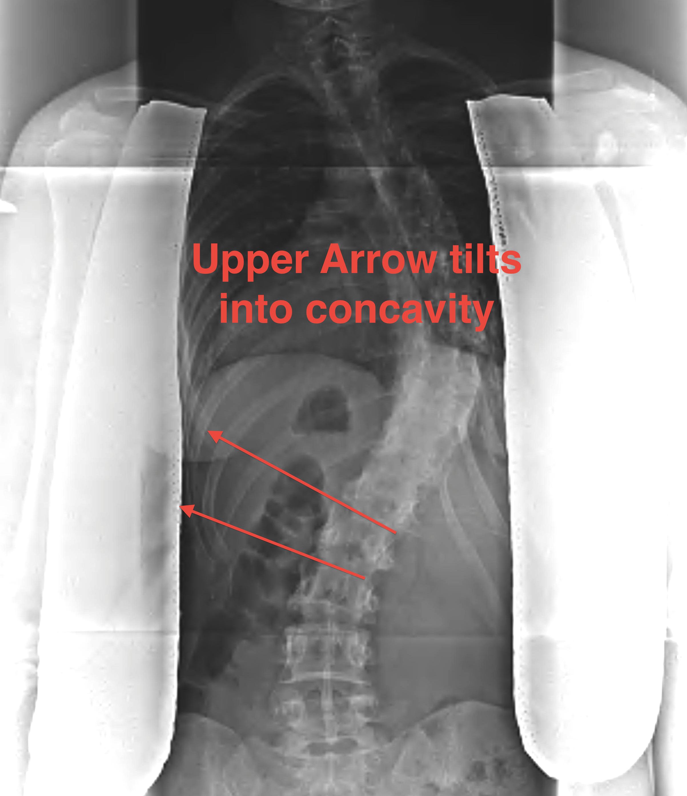 Scoliosis End Vertebrae